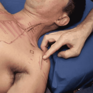 Precise-Points-Dry-Needling-Courses-in-Sydney-Melb