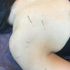 Level 1 Precise-Points-Dry-Needling-Courses-in-Sydney-Melbourne